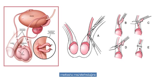 เป็นหมัน Beyond ivf มีลูกยากอยากมีลูก มีลูกแฝด ทำกิ๊ฟท์ IVF IUI ICSI ศูนย์รักษามีบุตรยาก