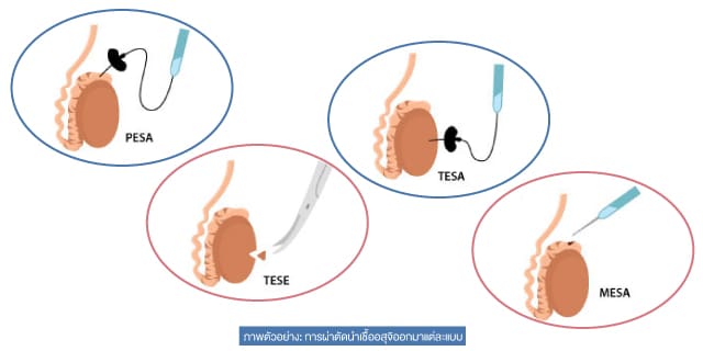เป็นหมัน Beyond ivf มีลูกยากอยากมีลูก มีลูกแฝด ทำกิ๊ฟท์ IVF IUI ICSI ศูนย์รักษามีบุตรยาก