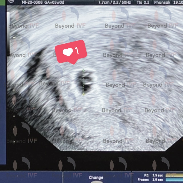 ตั้งครรภ์สำเร็จด้วยวิธี ICSI มีบุตรยาก อยากมีลูก มีลูกยาก อยากมีลูกแฝด ลูกแฝด ศูนย์รักษาผู้มีบุตรยาก Beyond IVF
