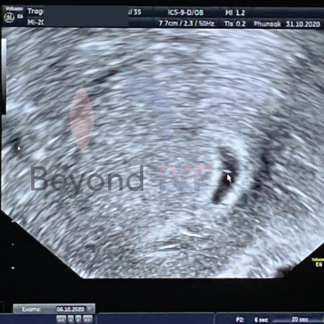ทำ ICSI ตั้งครรภ์สำเร็จ มีลูกยาก อยากมีลูก Beyond IVF