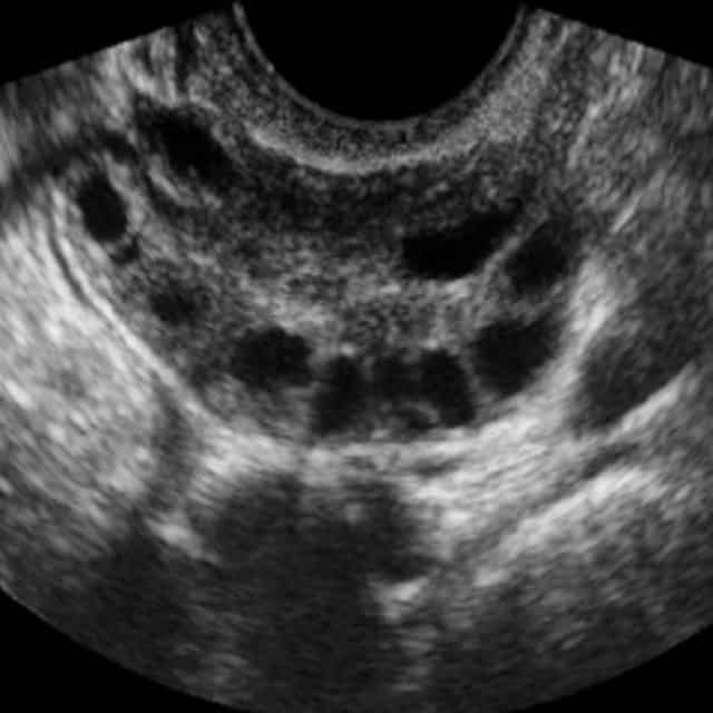 เป็น-PCOS-ภาวะถุงน้ำรังไข่หลายใบ-มีลูกด้วยวิธีเทคโนโลยีช่วยการเจริญพันธุ์ได้ไหม