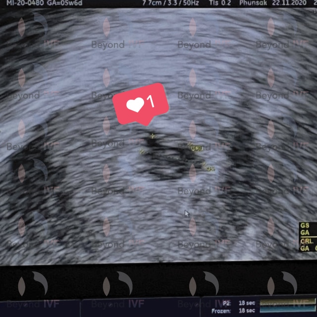 รักษาด้วยวิธี ICSI มีบุตรยาก อยากมีลูก มีลูกยาก อยากมีลูกแฝด ลูกแฝด ศูนย์รักษาผู้มีบุตรยาก Beyond IVF