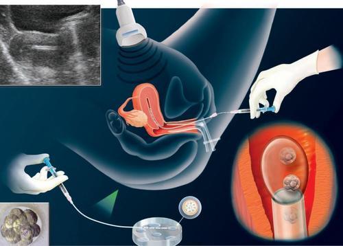 Beyond ivf มีลูกยากอยากมีลูก มีลูกแฝด ทำกิ๊ฟท์ IVF IUI ICSI ศูนย์รักษามีบุตรยาก