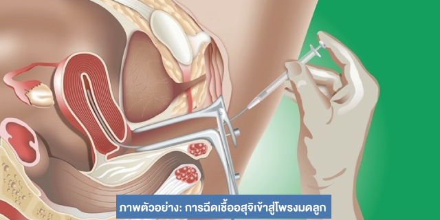 รักษาด้วยวิธี IUI Beyond ivf มีลูกยากอยากมีลูก มีลูกแฝด ทำกิ๊ฟท์ IVF IUI ICSI ศูนย์รักษามีบุตรยาก