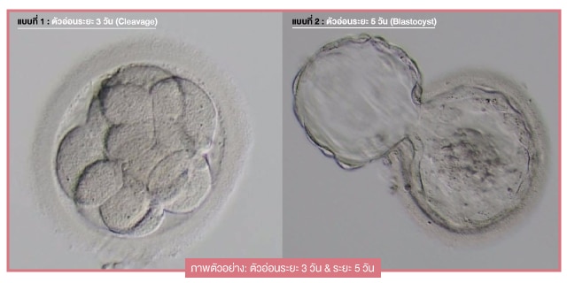 ตัวอ่อนระยะ 3 วัน VS 5 วัน ระยะไหนมีโอกาสสำเร็จมากกว่า beyond ivf หมอต้น พูนศักดิ์