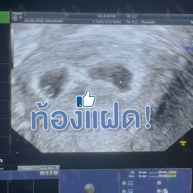 Beyond ivf มีลูกยากอยากมีลูก มีลูกแฝด ทำกิ๊ฟท์ IVF IUI ICSI ศูนย์รักษามีบุตรยาก