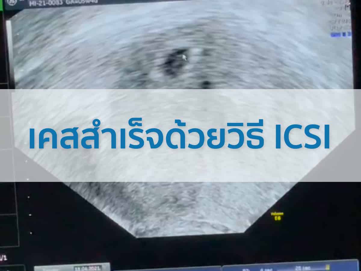 review-วิธี ICSI รีวิว IVF-Beyond IVF