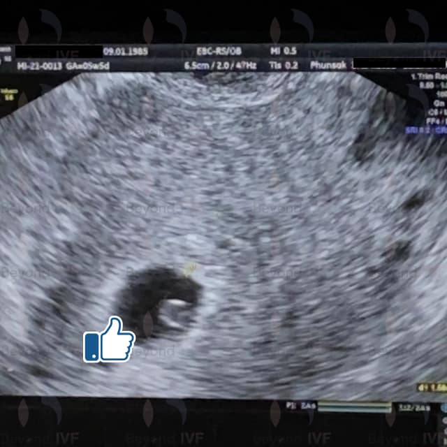 วิธี ICSI Beyond ivf มีลูกยากอยากมีลูก มีลูกแฝด ทำกิ๊ฟท์ IVF IUI ICSI ศูนย์รักษามีบุตรยาก