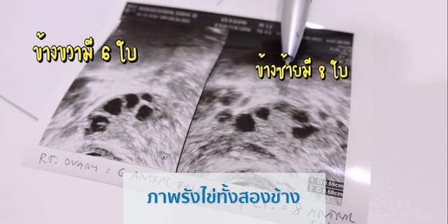 ฝากไข่ รีวิวฝากไข่ ที่ Beyond-IVF