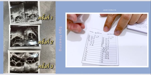 ฝากไข่ รีวิว โดย beyondivf