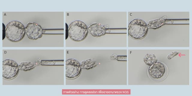 IVF ICSI เลือกเพศ มีลูกยาก อยากมีลูก Beyond IVF