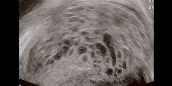 ตั้งครรภ์ไข่ปลาอุก มีลูกยาก อยากมีลูก Beyond IVF