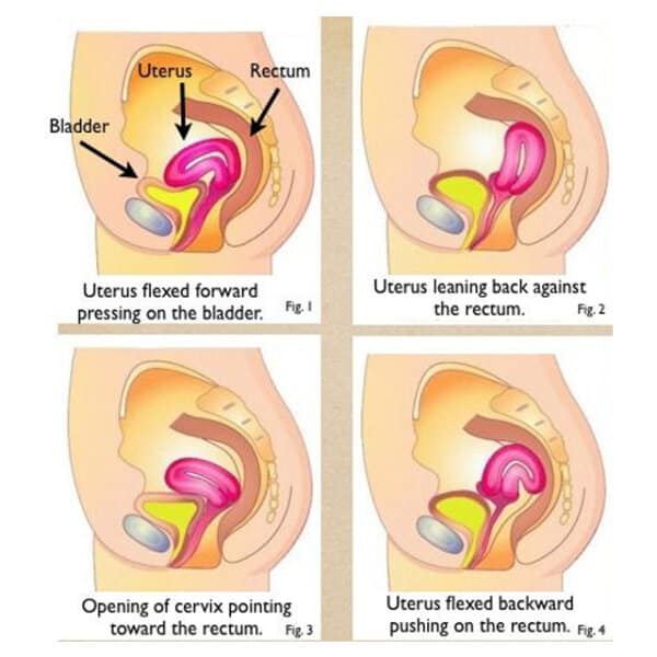 มดลูกต่ำ มดลูกคว่ำ มดลูกต่ำหรือมดลูกคว่ำคืออะไร Beyond IVF