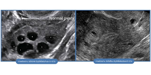 อายุ 40ปี ยังฝากไข่ได้ไหม อยากมีลูก มีลูกยาก Beyond IVF