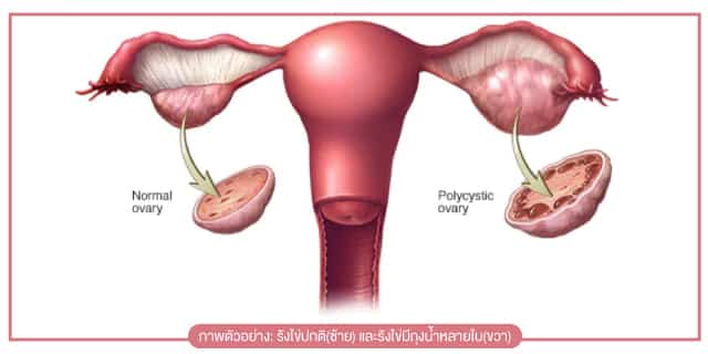 โรคถุงน้ำในรังไข่หลายใบ หรือ PCOS คืออะไร Beyond IVF