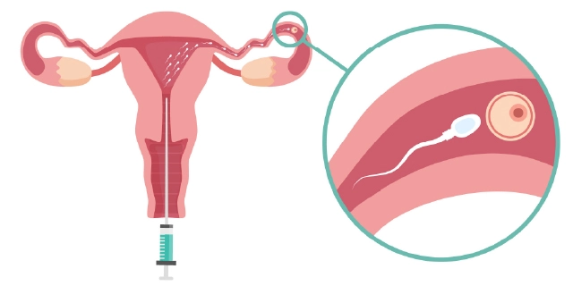 IUI การฉีดเชื้ออสุจิเข้าสู่โพรงมดลูก รักษามีบุตรยาก