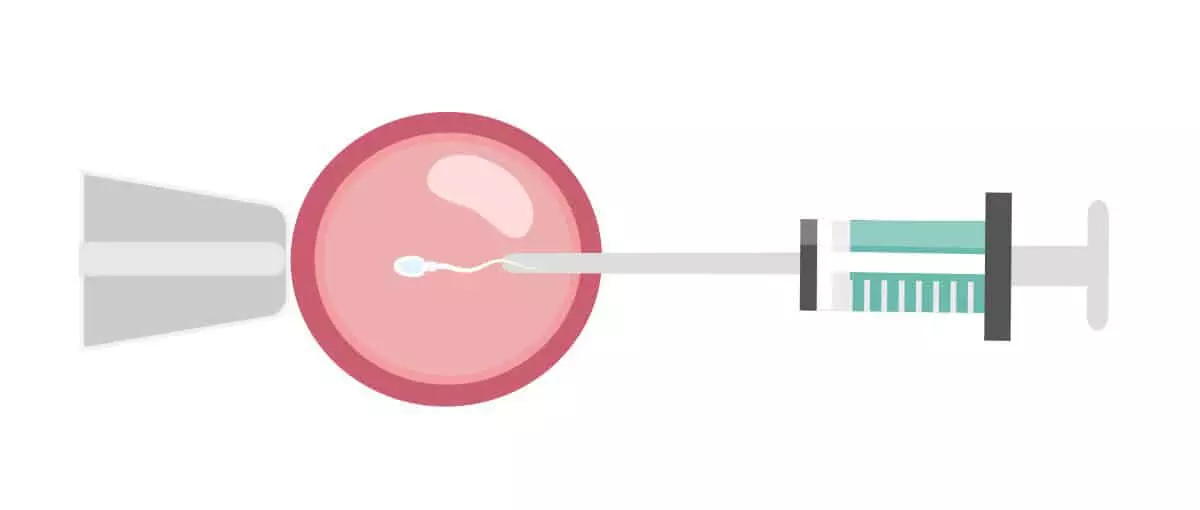 การทำเด็กหลอดแก้ว IVF ICSI รักษามีบุตรยาก