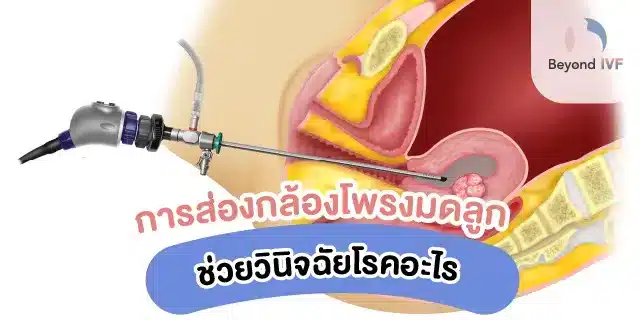 การส่องกล้องโพรงมด