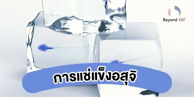 การแช่แข็งอสุจิ