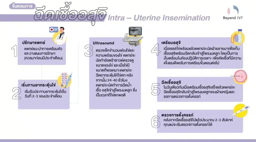 ขั้นตอนการทำ IUI