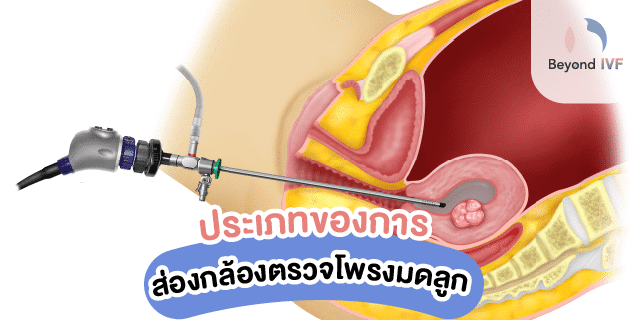 ประเภทของการส่องกล้องตรวจโพรงมดลูก