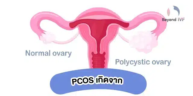 ภาวะถุงน้ำรังไข่หลายใบ