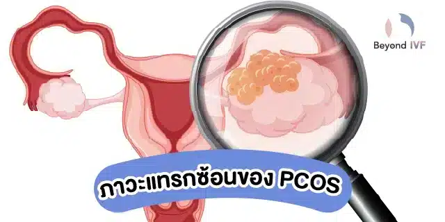 ภาวะแทรกซ้อนที่อาจเกิดจาก PCOS