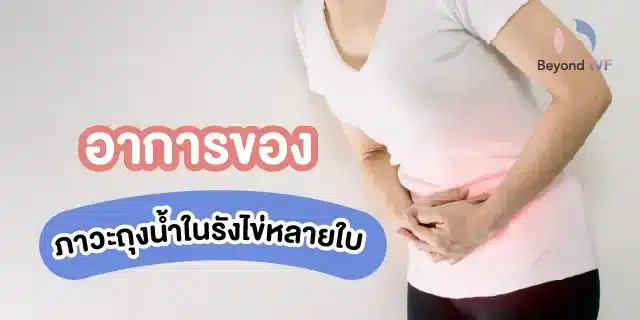 อาการถุงน้ำรังไข่หลายใบ