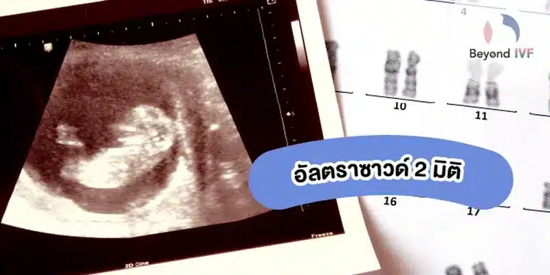 อัลตร้าซาวด์ 2 มิติ