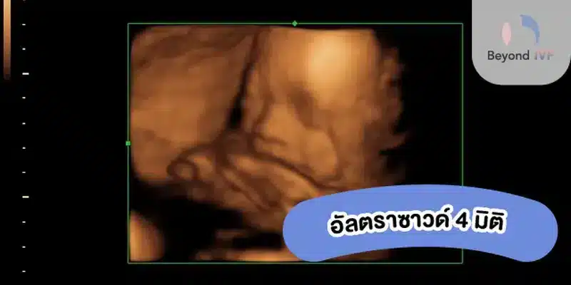 อัลตร้าซาวด์ 4 มิติ