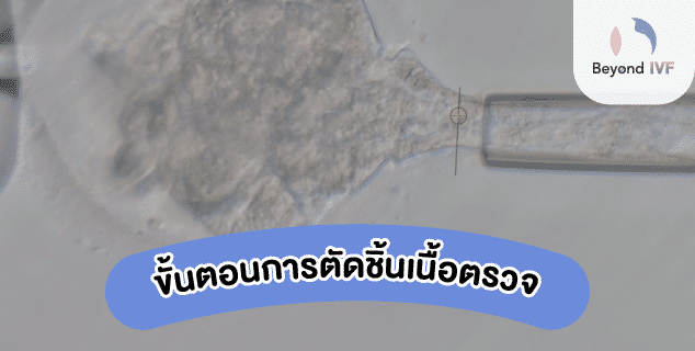 Beyond IVF ส่งตรวจโครโมโซม ได้อันดับ1.