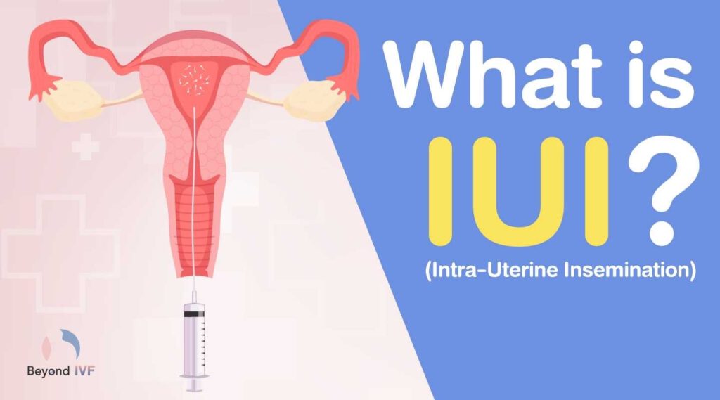 IUI