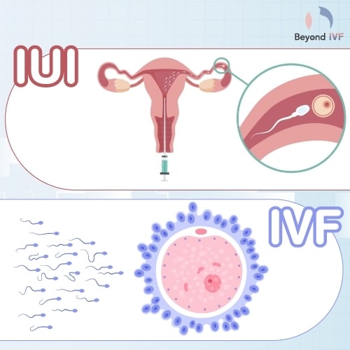 iui treatment