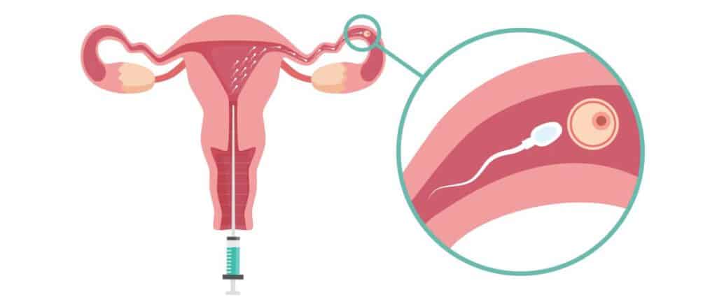 iui fertility treatment