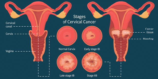 cervical screening