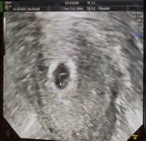 icsi success tubal ligation