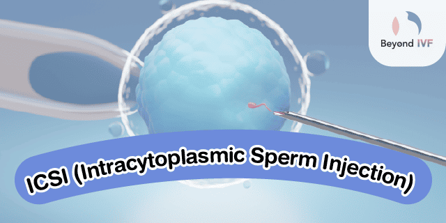Intracytoplasmic Sperm Injection ICSI
