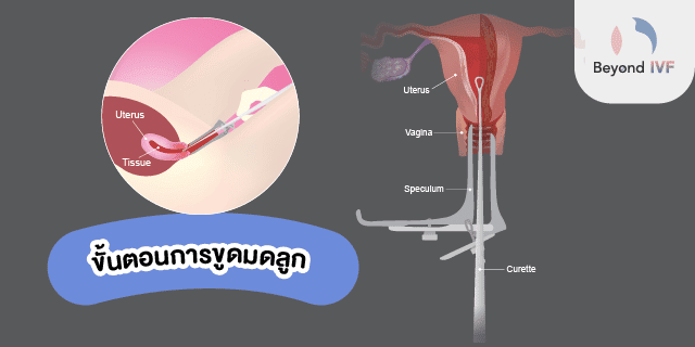 การขูดมดลูก
