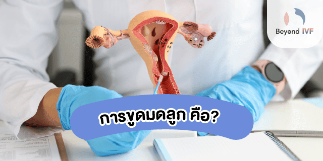 ขูดมดลูก คือ