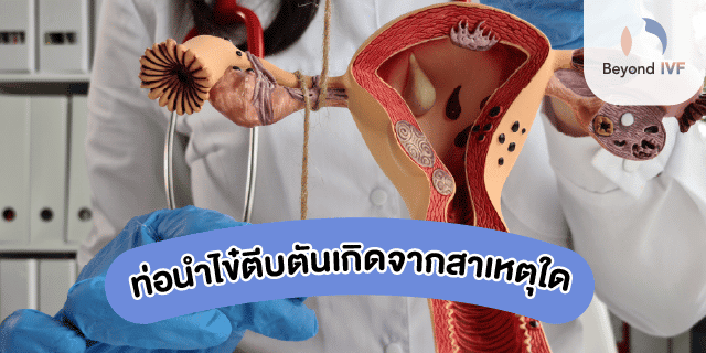 ท่อรังไข่ตัน อาการ
