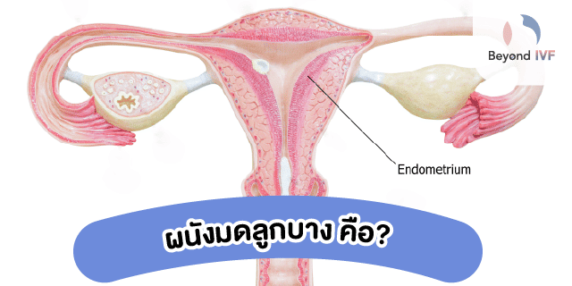 ผนังมดลูกบางคืออะไร
