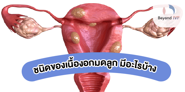อาการเนื้องอกมดลูก