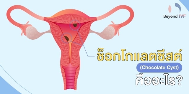 เกี่ยวกับโรคช็อกโกแลตซีส