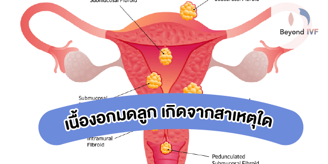เนื้องอกในมดลูก