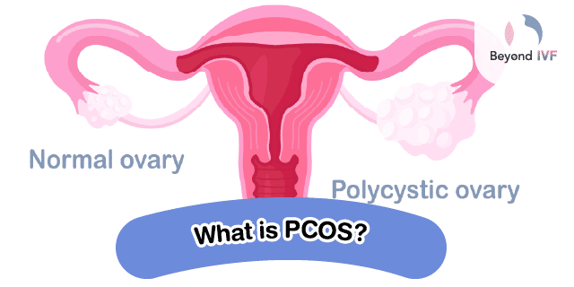 pcos pregnancy