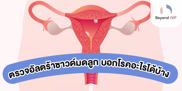 วิธีอัลตร้าซาวด์มดลูก