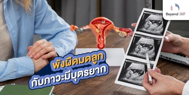 พังผืดมดลูกกับภาวะมีลูกยาก