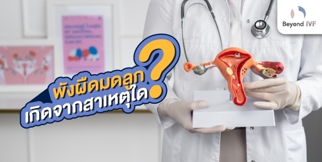 พังผืดมดลูก เกิดจาก